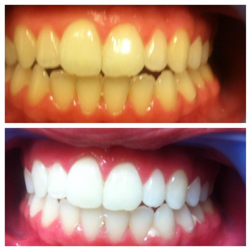 Strisce sbiancanti denti pap - strisce,